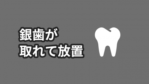 取れた銀歯(詰め物)を5年放置して歯医者さんにめちゃくちゃ怒られた話